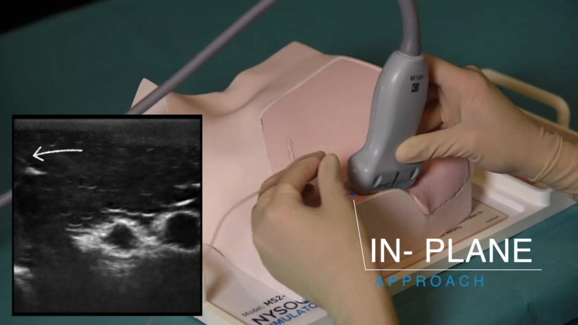 MiniSim Infraclavicular Brachial Plexus/PEC 1&2/ Parasternal Block Ultrasound Scan